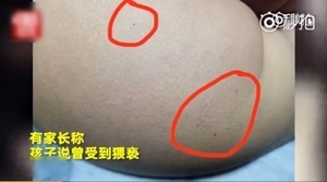 北京幼兒園又現虐童 幼童遭猥褻扎針餵藥片