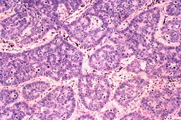 納米顆粒可以偵測到很小的癌症組織。圖為經染色的組織細胞。（Flickr）