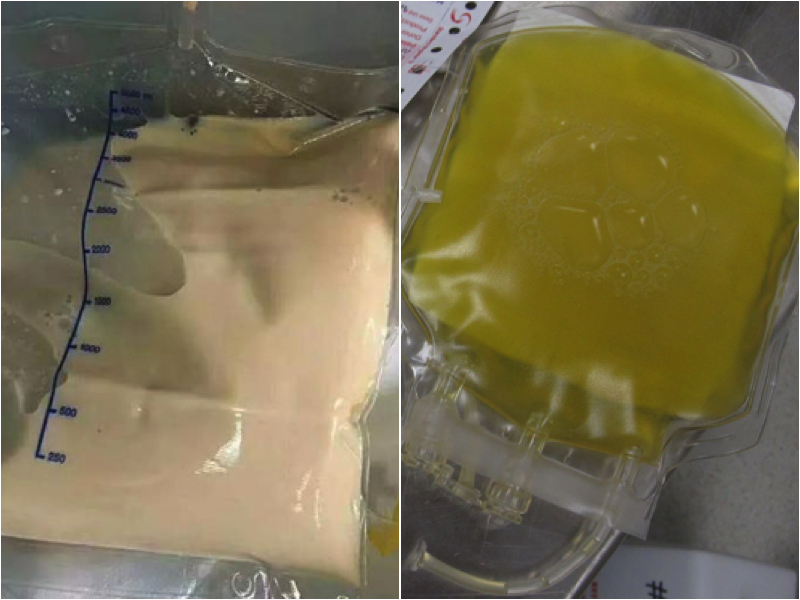 小琳血液中抽出的「豬油色」血漿（左）同正常血漿（右）的對比。（網絡圖片合成）