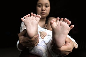 男嬰患多指症 手指腳趾共31根