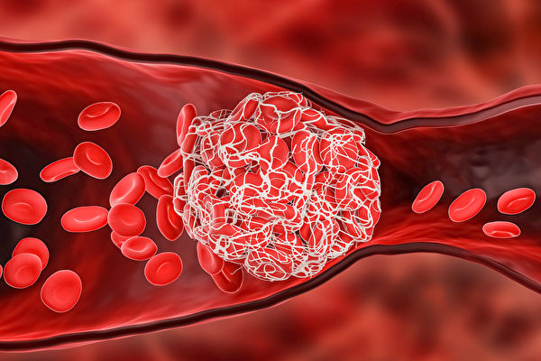 Delta變種病毒更容易產生血栓、心肌炎。（Shutterstock）