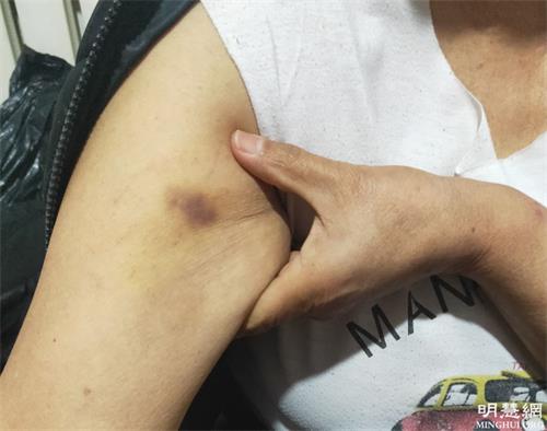 2021年3月19日，警察強迫劉英傑按手印，造成她胳膊瘀青。（明慧網）