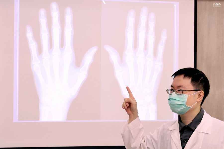疫情下手部退化性關節炎增 嚴重恐侵蝕關節