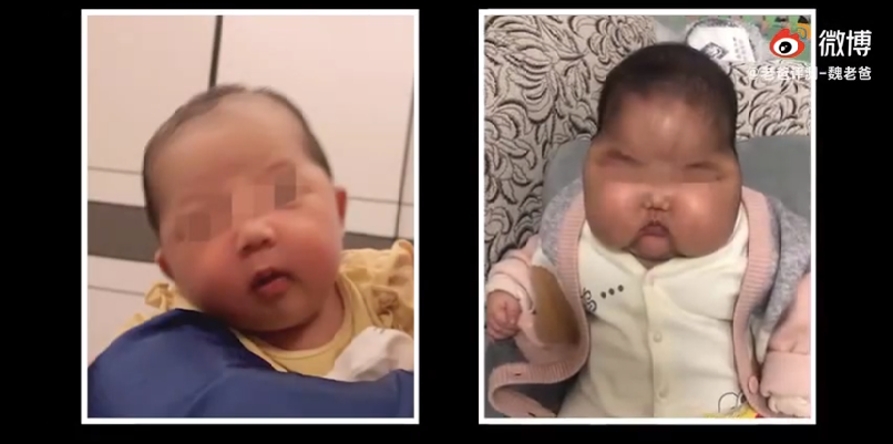 大陸一名5個月大女嬰使用一款嬰兒霜兩個月後，出現「大頭娃娃」類似症狀。左圖是該嬰兒正常時的樣子，右圖是患病後的樣子。（影片截圖）