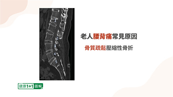 壓縮性骨折使第一腰椎的椎體呈現楔形。（健康1+1／大紀元）