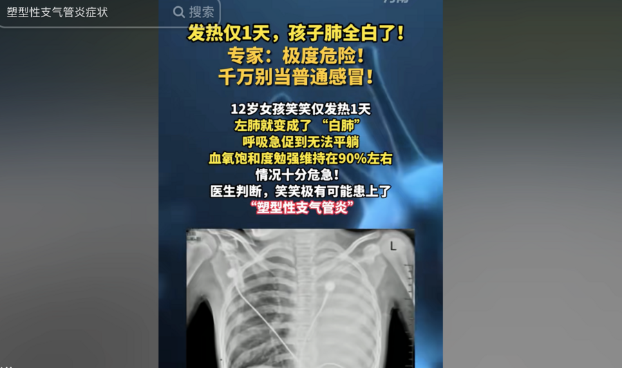 浙江女孩發熱一天後左肺全白 原因成謎