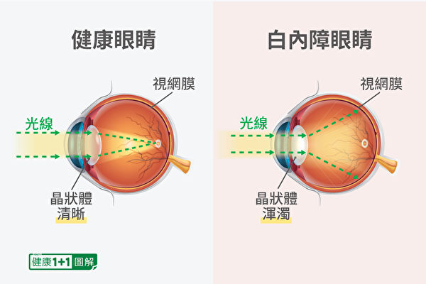 白內障是眼睛晶狀體的漸進性混濁，讓視力變得模糊。（健康1+1／大紀元）