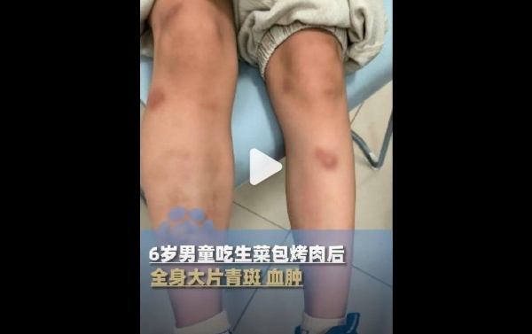 深圳男童吃生菜後全身血腫 檢出鉤蟲感染