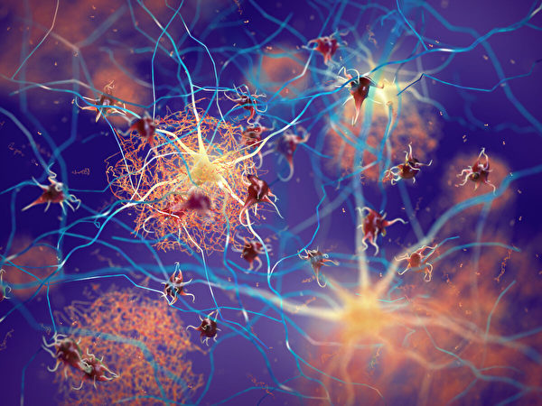 神經元之間的澱粉樣斑塊。（Shutterstock）
