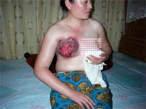 法輪功學員王雲潔被電擊後潰爛的乳房。（明慧網）