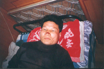 子彈擦傷了這位黑龍江法輪功學員的鼻子。（明慧網）