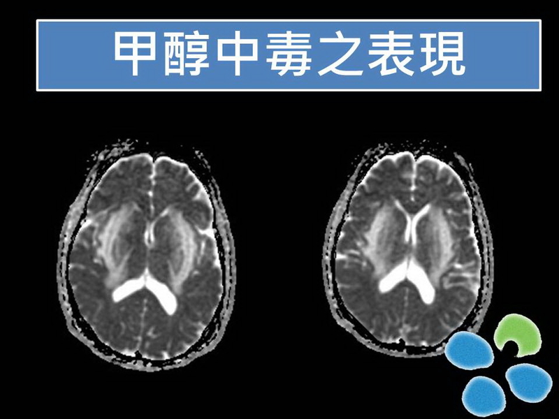 誤將工業酒精當白酒 湖北三人中毒已一死