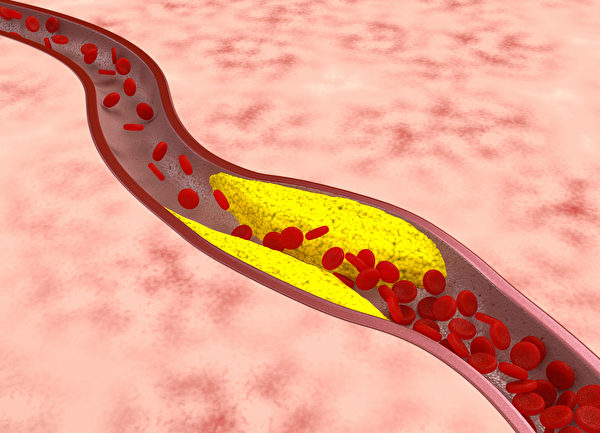 脂肪和壞膽固醇堆積在血管壁上且越堆越厚，血管越來越狹窄、硬化。（Fotolia）