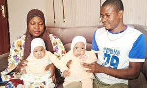 連體雙胞胎女嬰在尼日利亞醫院成功分離