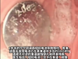 南京幼兒誤食紐扣電池造成終身殘疾