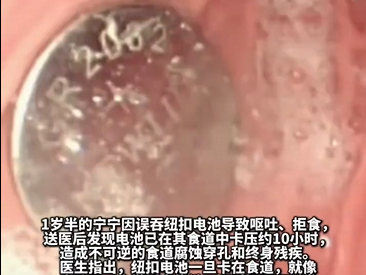 南京幼兒誤食紐扣電池造成終身殘疾