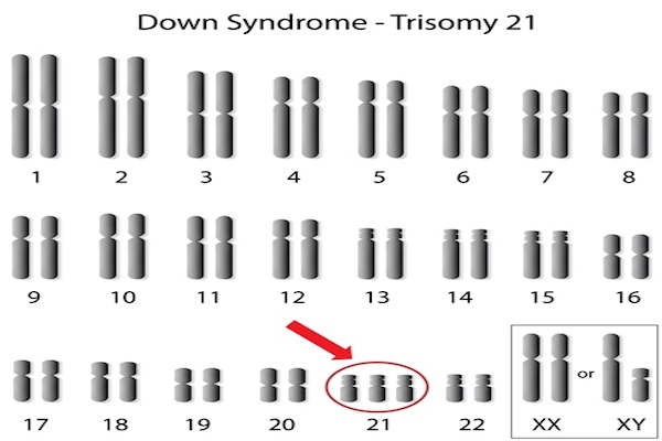 唐氏症患者的第21條染色體有三份拷貝。示意圖。（Shutterstock）