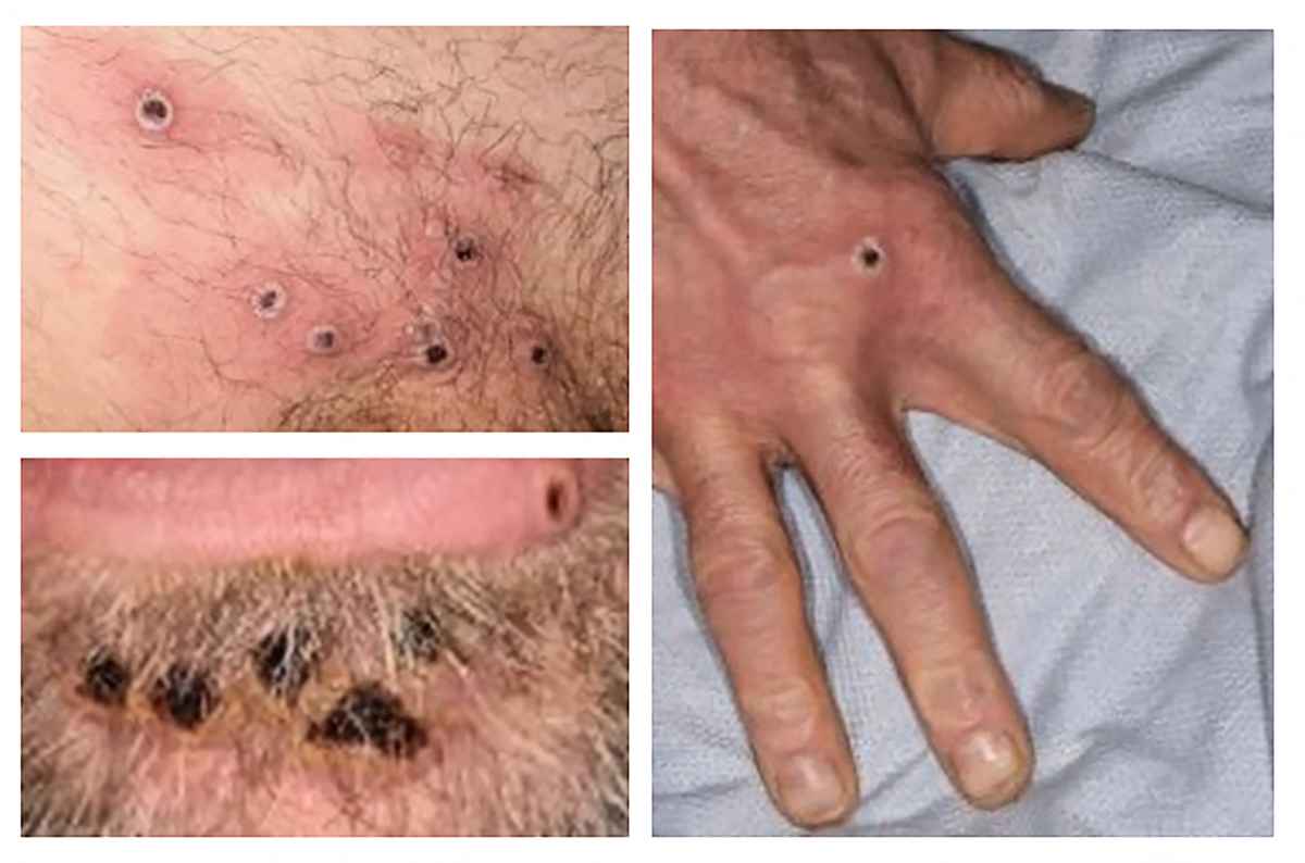 英國衛生安全局2022年6月22日公布的圖片，顯示猴痘皮疹病變症狀。（UK Health Security Agency / AFP）