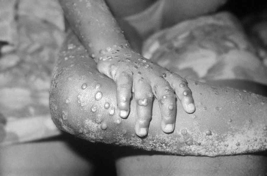 德國猴痘病例已超過2千 幾乎均為男患者