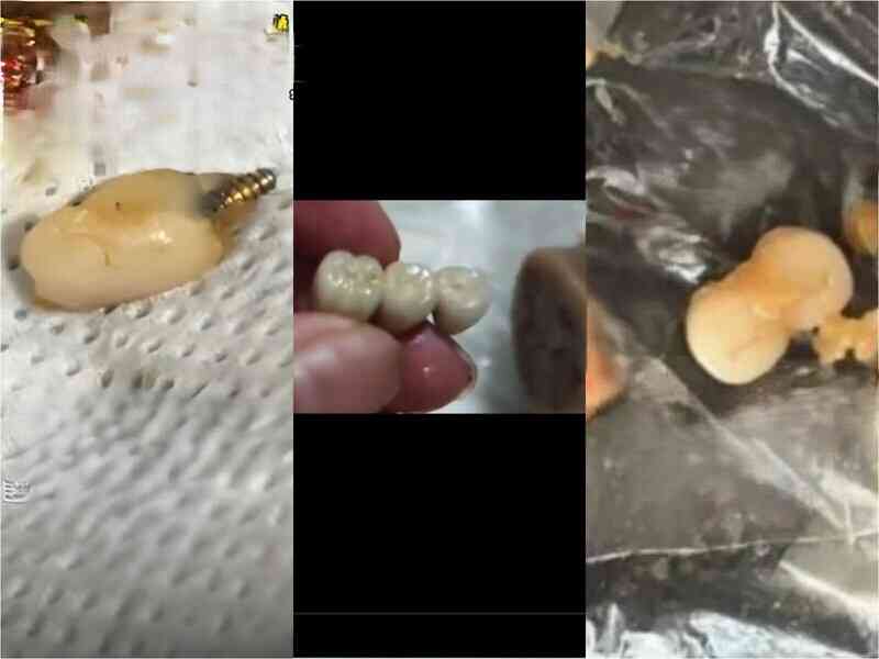 吉林民眾在香腸裏吃出「3顆牙齒」