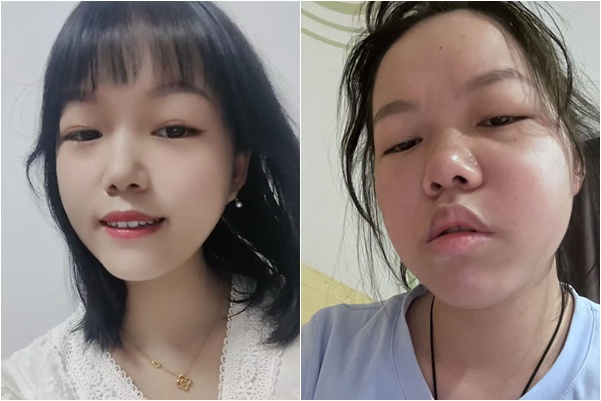 湖北疫苗受害者長期遭打壓 身心疲憊