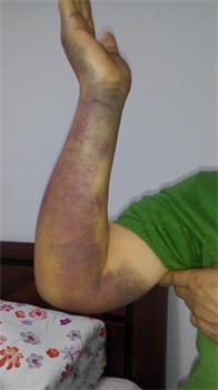 高國慶的妻子被扭傷的手臂。（明慧網）
