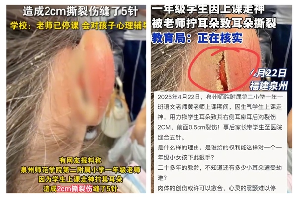 福建一年級女童上課走神 遭老師揪耳 撕裂二厘米