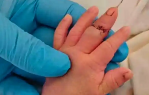 江蘇新生兒遭無端橫禍 護士剪臍帶時剪斷其手指