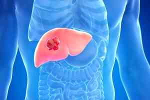 肝癌60%可預防!世衛專家教你如何守護肝臟健康