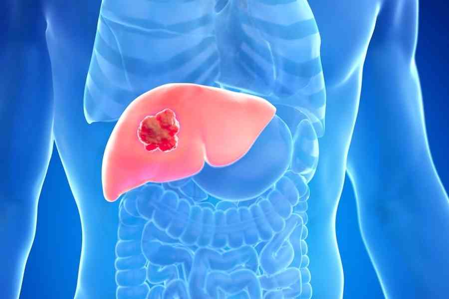 肝癌60%可預防！世衛專家教你如何守護肝臟健康
