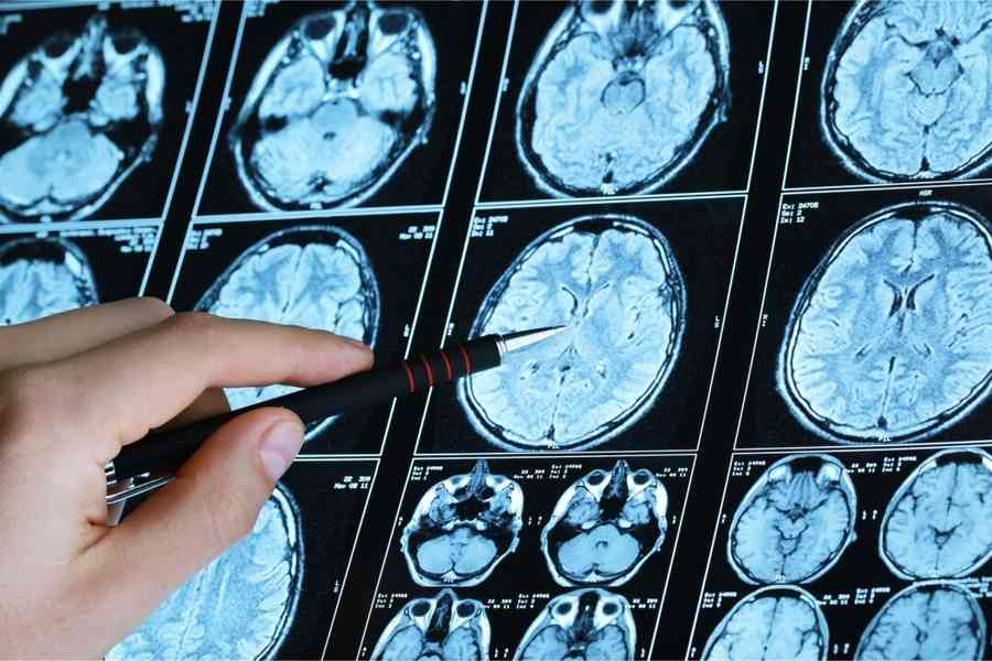 護腦防失智 血壓控制是關鍵