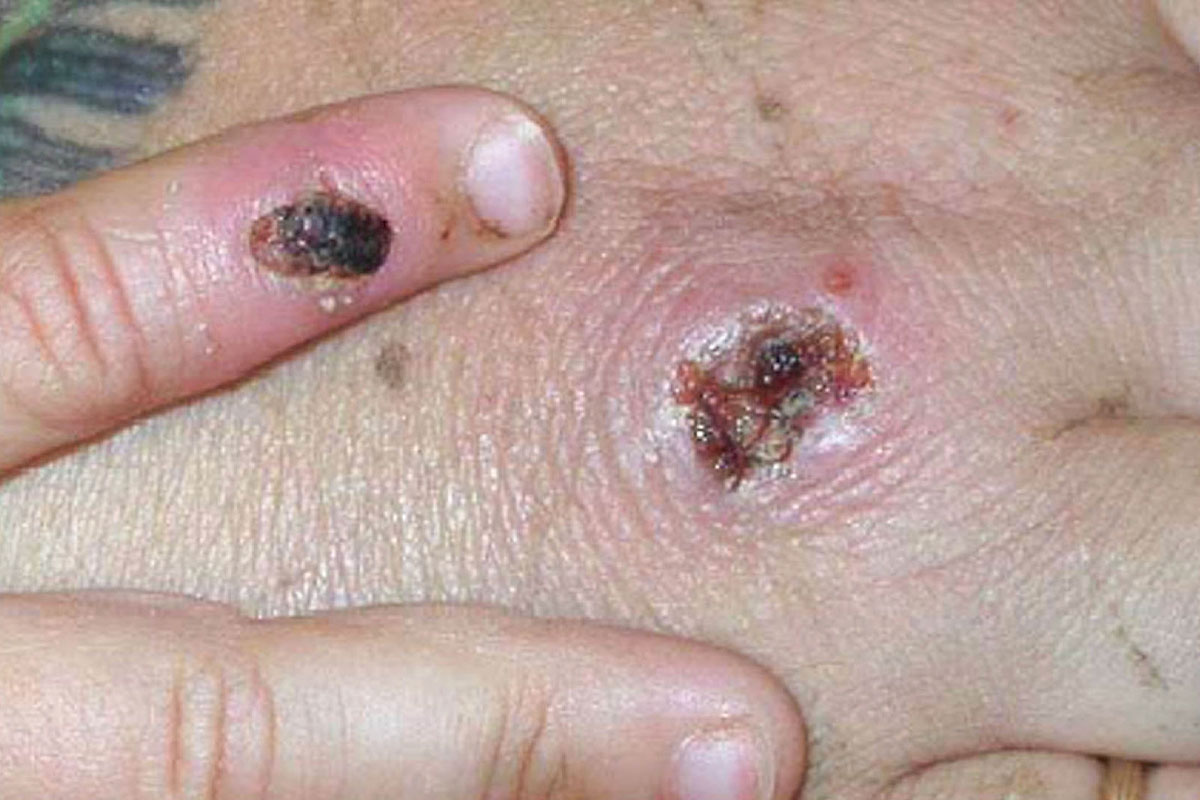 原來只在非洲傳播的猴痘，目前在歐洲和北美出現。（Getty Images）