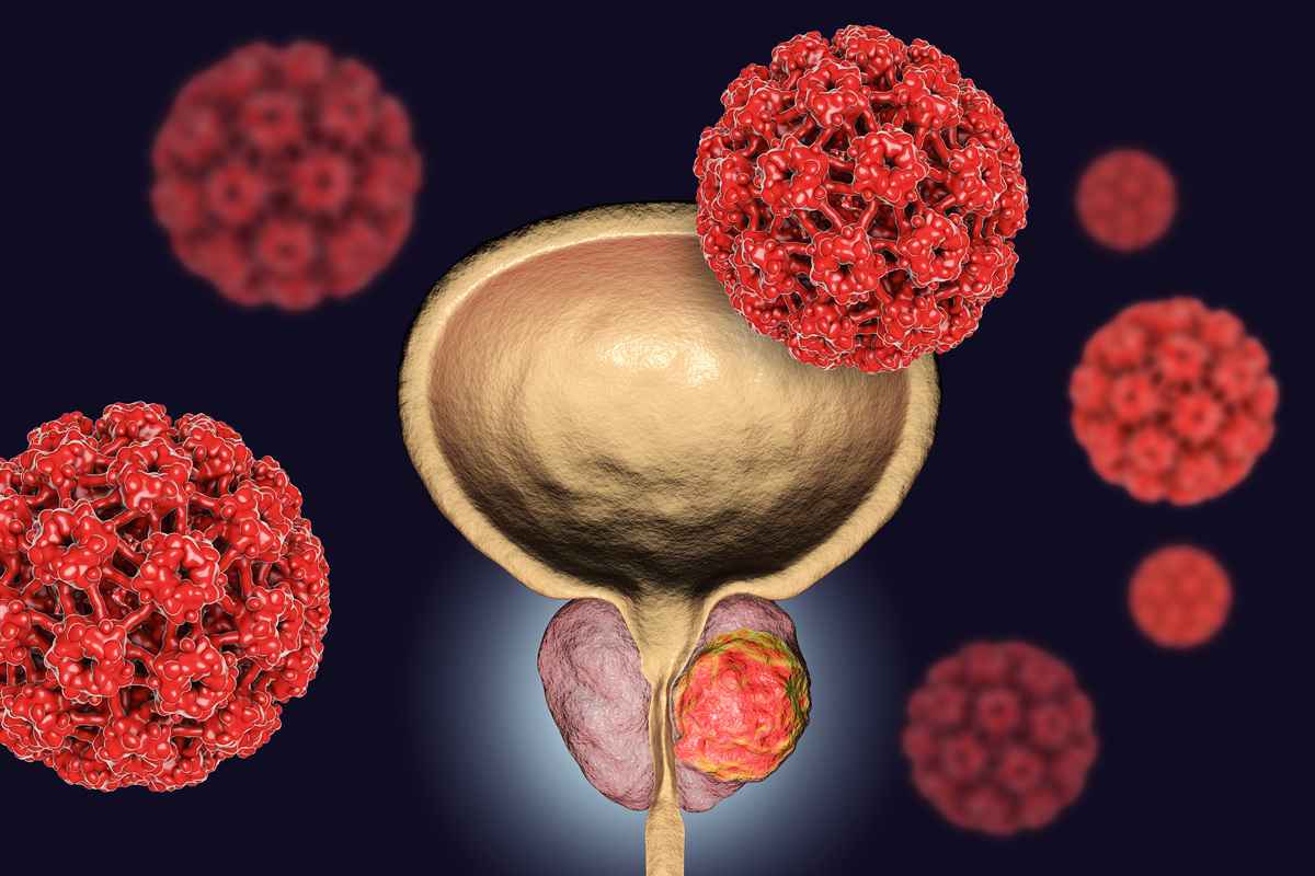  前列腺癌與細菌示意圖。（Shutterstock）