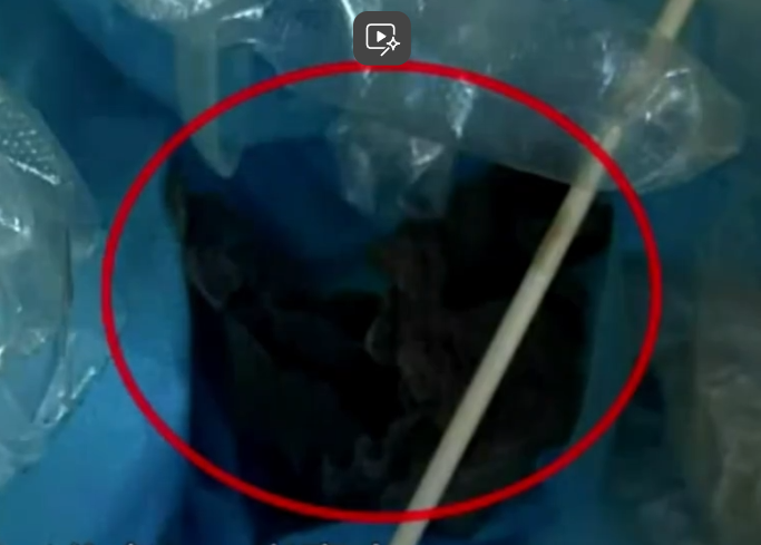 內蒙女子做體檢紗布被留在體內20天