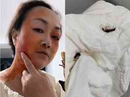 濟南多地現隱翅蟲 多人遭襲擊