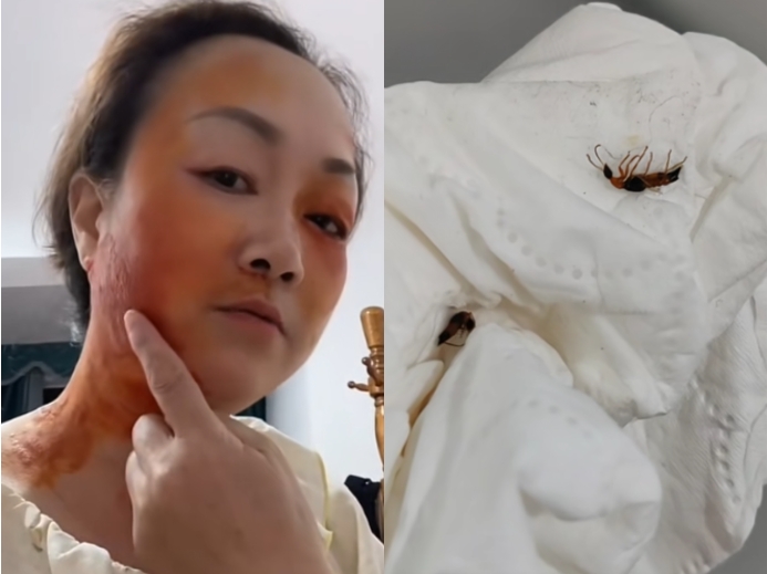 濟南多地現隱翅蟲 多人遭襲擊