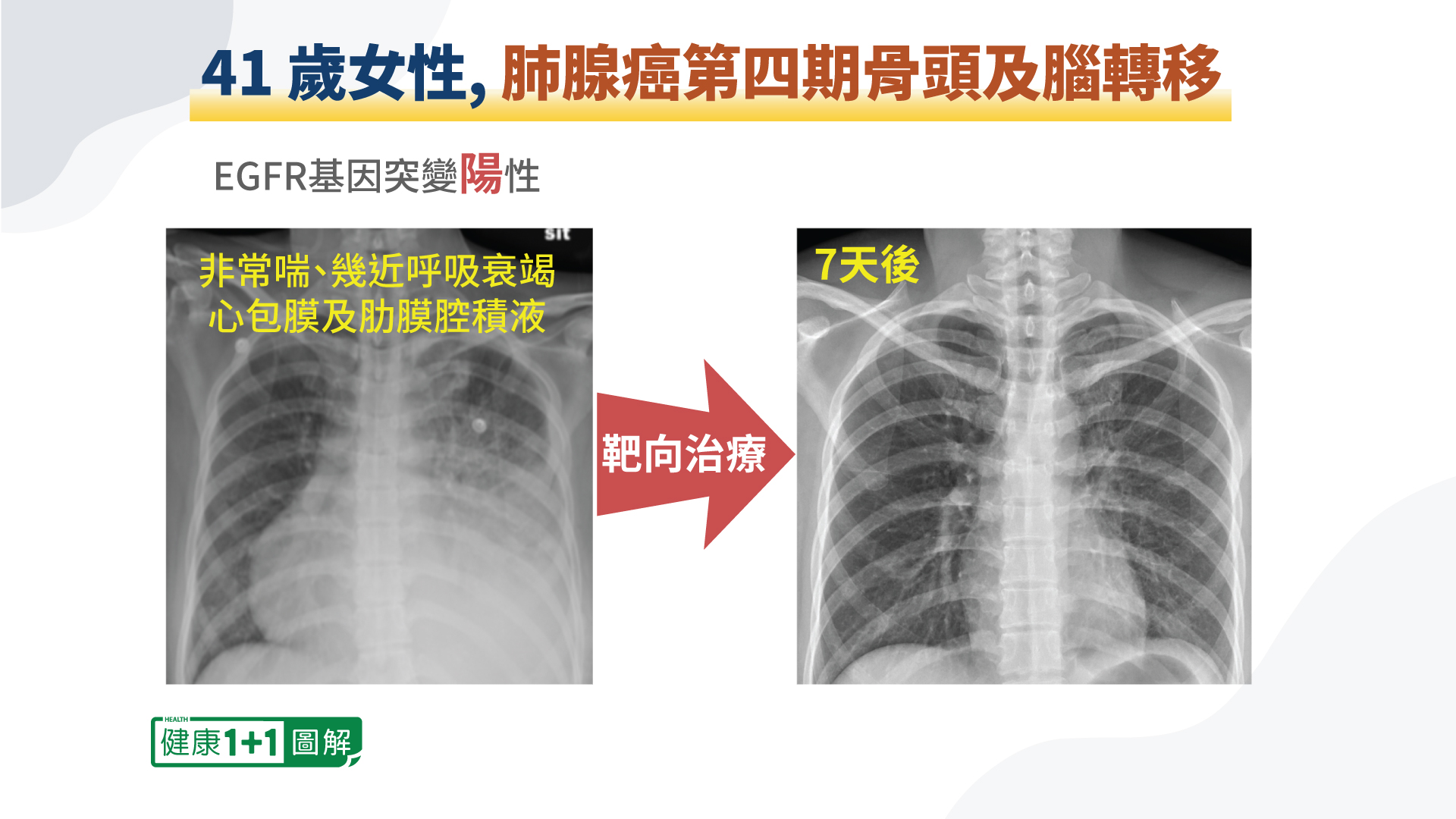 肺腺癌症狀不明顯發現時大多已晚期！哪些療法可能治癒｜大紀元時報香港 