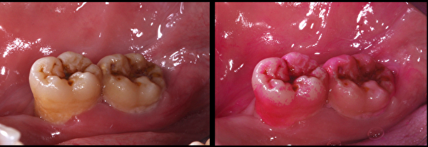 牙齒內側靠近舌頭的部位有大範圍的粉紅色區塊，正是沒有刷乾淨的牙菌斑。（徐志中醫師提供）