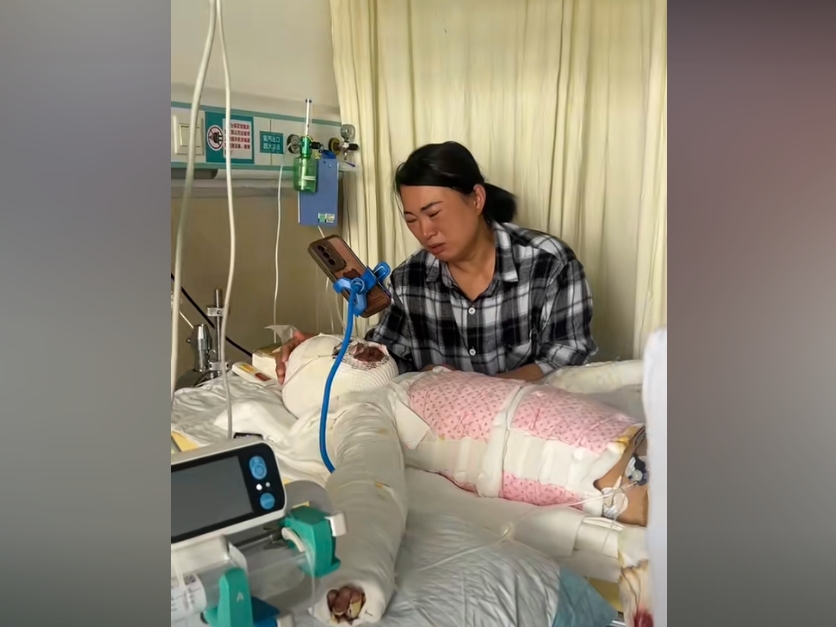 河南8歲女孩開燈引發煤氣爆炸 身體58%燒傷
