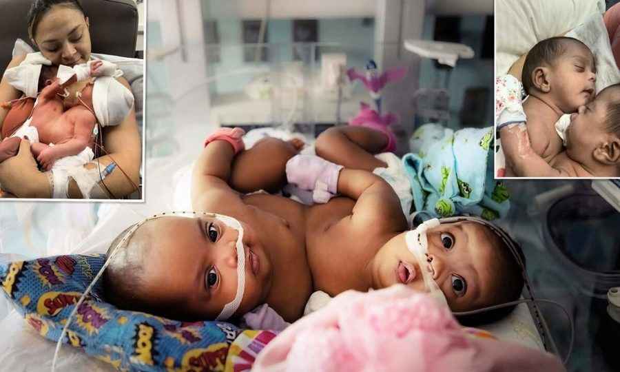 美國兒童醫院成功分離16周大連體雙胞胎