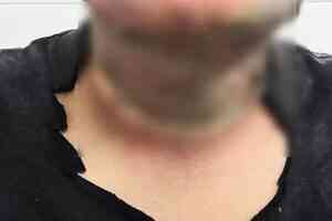 杭州男子暖爐旁擦酒精消毒 瞬變火球燒傷