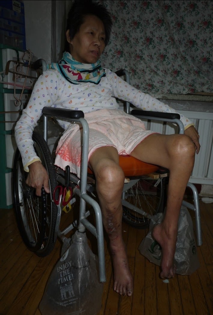 葉旭霞因不放棄修煉法輪功,在中共勞教所被毆打致重傷,導致殘疾和癱瘓。(圖片由葉旭霞女兒提供)