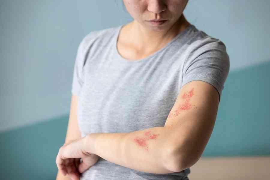 三高患者罹帶狀疱疹風險高 嚴重恐失明