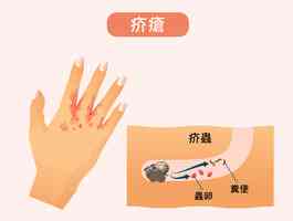 深圳多個家庭感染疥瘡 醫生：傳染性極強