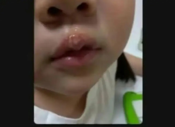  江蘇徐州幼童被曝遭教師用熱熔膠燙嘴