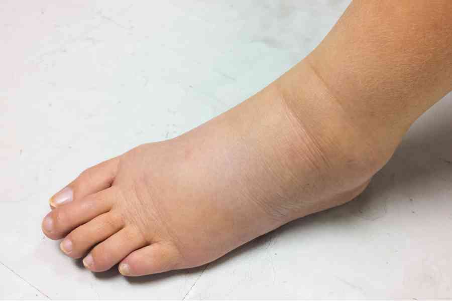 無需壓力襪或藥物 專家教你消除腳腫的方法