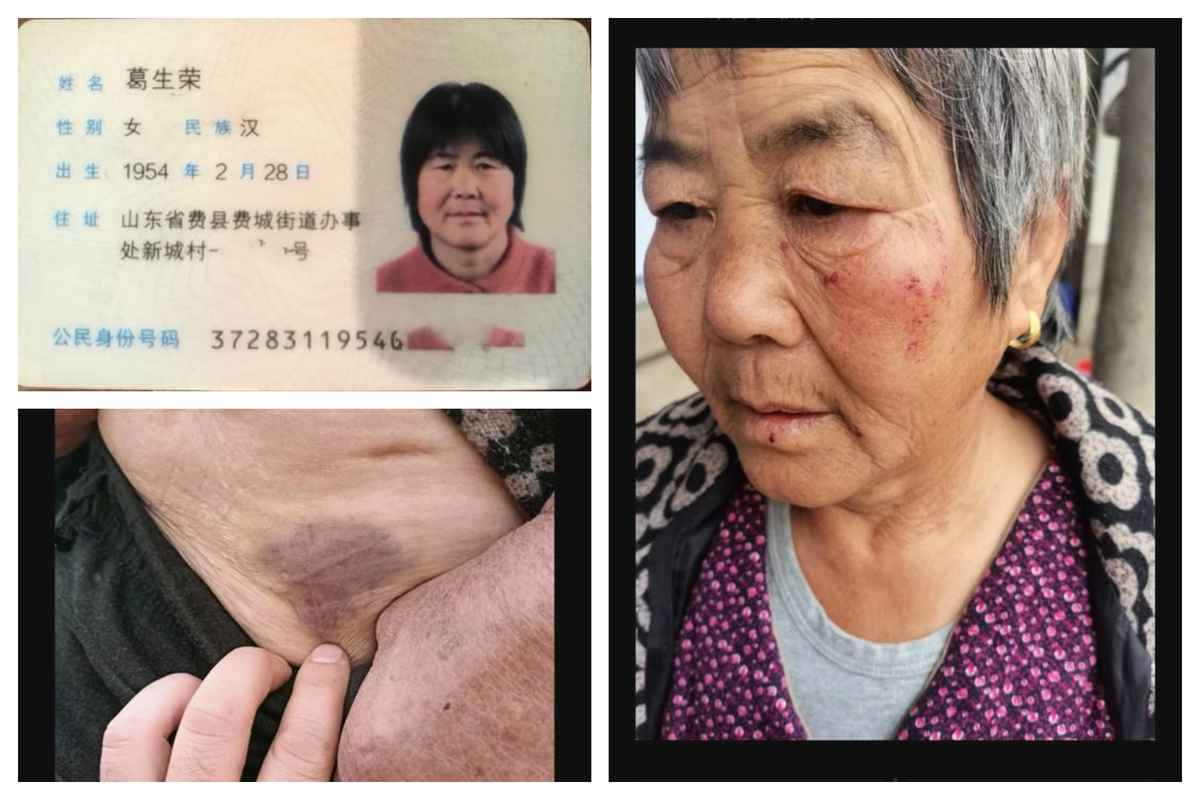 山東臨沂費縣村民葛生榮被打，經警方強制調解後冤死。圖為老人被打傷的部份照片。（受訪者提供）