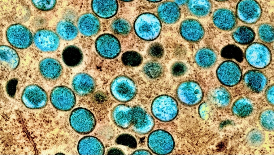 中國猴痘疫情擴散 29天新增逾百例