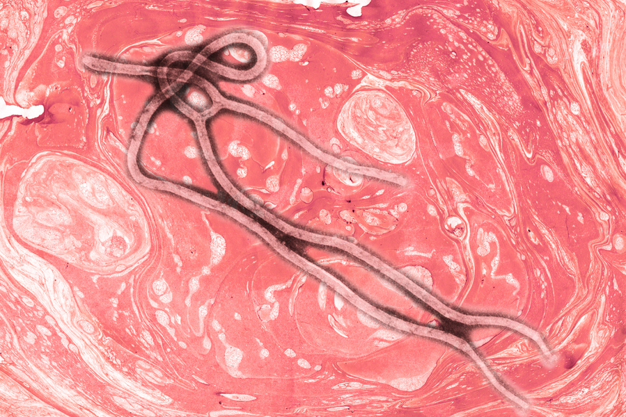 研究：伊波拉病毒可藏腦中 治癒後還會復發
