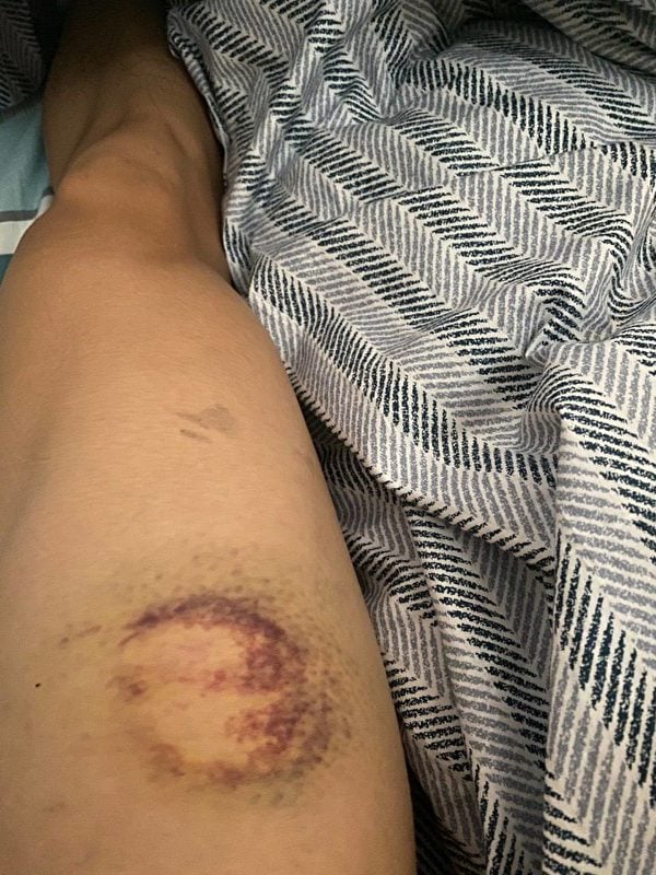 2019年，Wesley Ho參與香港「反送中」運動大腿受傷。（Wesley Ho提供）